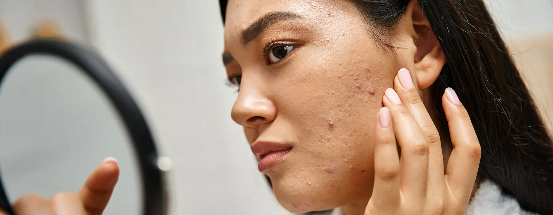 Skin Deep: The Relationship Between Acne and Depression