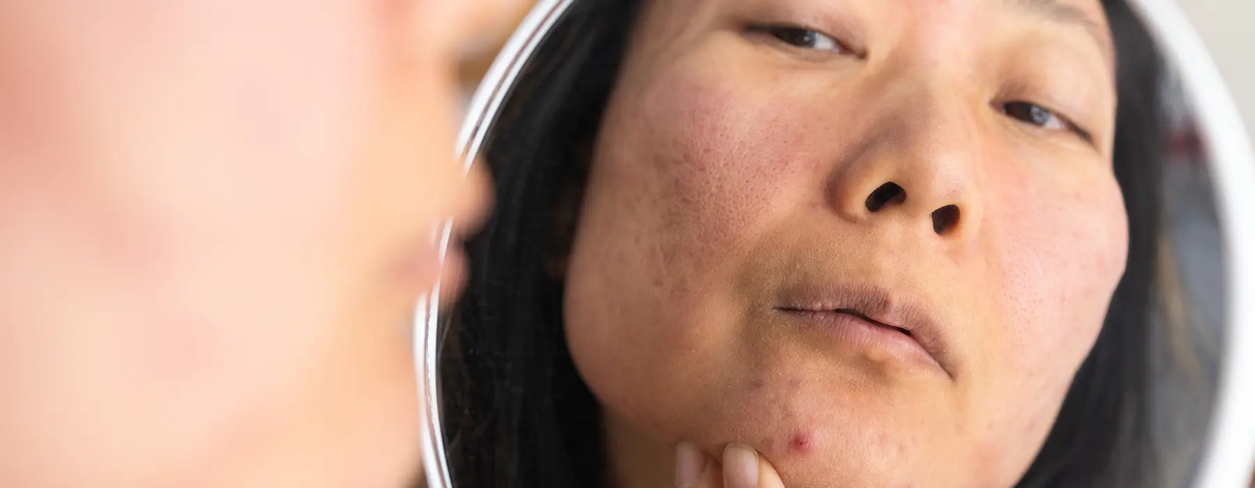 Laser Treatment for Acne Scars: Your Path to Clearer Skin
