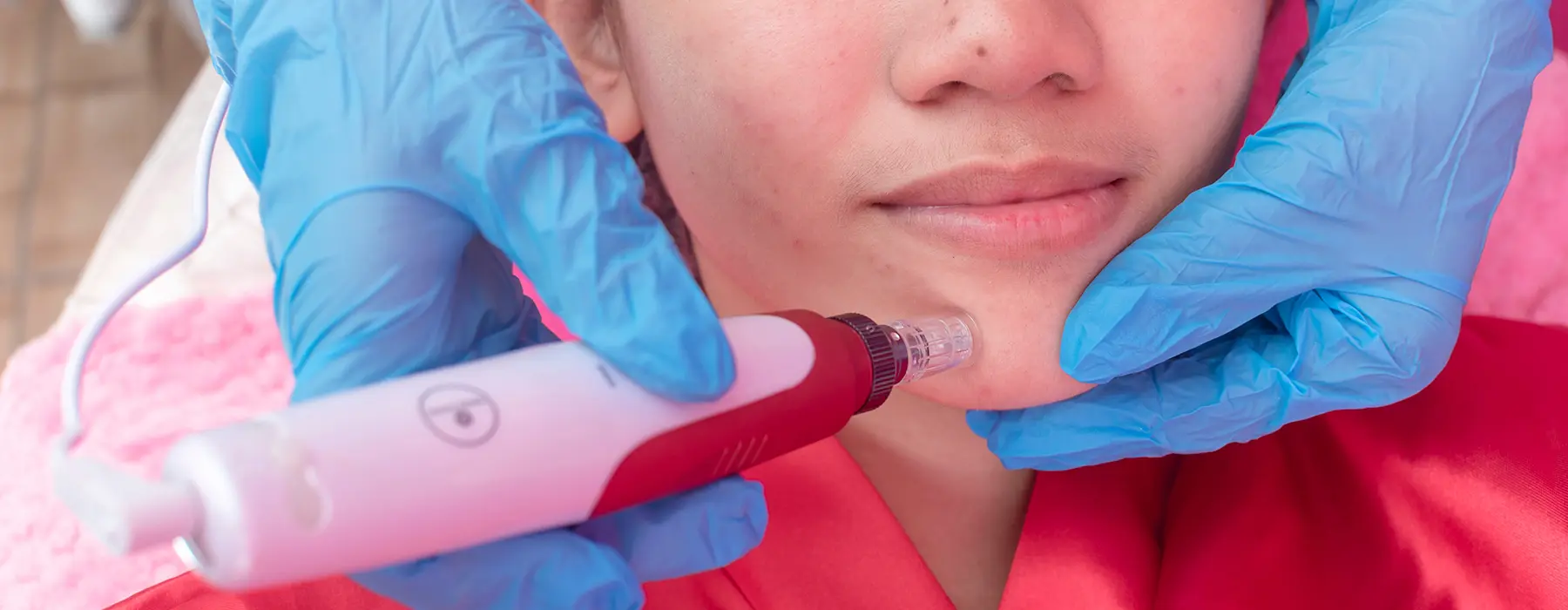 How PRP and Microneedling Work Together to Fade Acne Scars