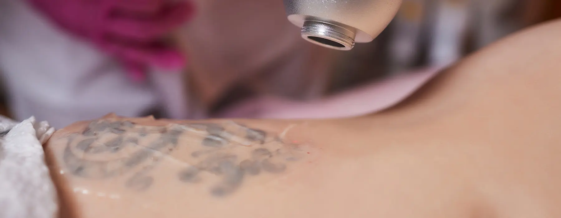 No Judgment, Just Results: Our Approach to Tattoo Removal