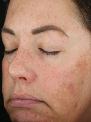 Patient Before DiamondGlow® Treatment